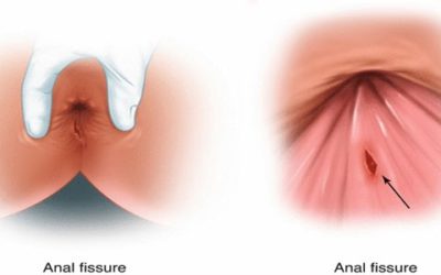 Anal Fissür (Makat Çatlağı) Belirtileri Nelerdir?